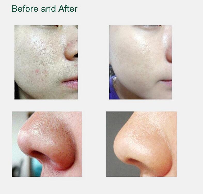 Facial Microdermabrasion