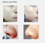 Facial Microdermabrasion