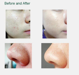 Facial Microdermabrasion