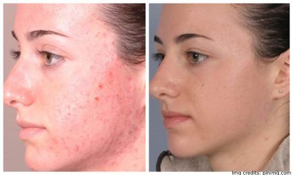 Facial Microdermabrasion