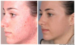 Facial Microdermabrasion