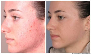 Facial Microdermabrasion