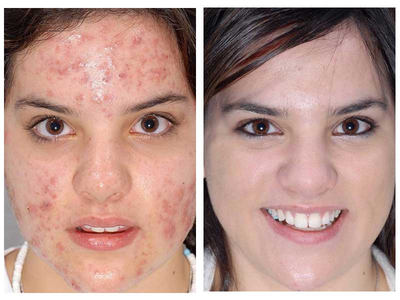 Facial Microdermabrasion